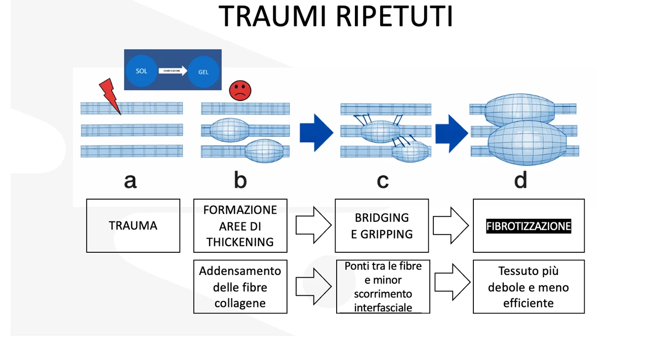 Syntesi MCB - Traumi meccanici ripetuti del tessuto fasciale possono far si che il processo di adattamento e normale riparazione, da parte dei fibroblasti, non vada a buon fine. Si potrà sviluppare così un fenomeno di infiammazione cronica, così come potrà verificarsi quella che viene definita densificazione della fascia (Fabio Perissinotti)